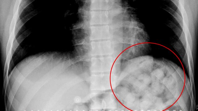 Midesinden 900 gram uyuşturucu madde çıktı