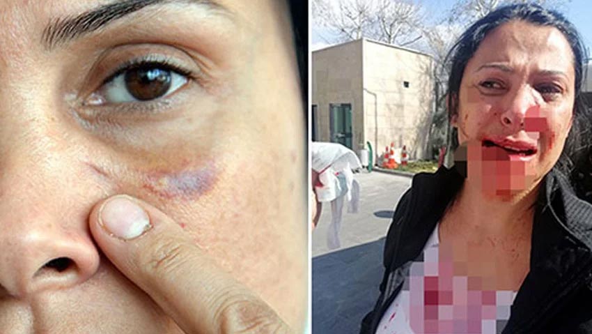 Öğretmen dehşet saçtı!.. Polislerin gözü önünde komşusunun yüzüne kalem sapladı!