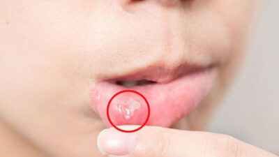 Aft yarasını 1 saatte geçiren yöntem!