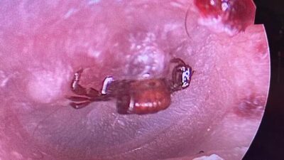 Ağrı şikayetiyle gitti! Kadının kulak zarından kene çıktı