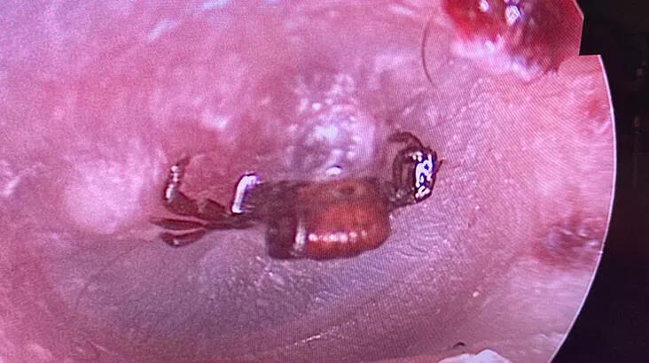 Ağrı şikayetiyle gitti! Kadının kulak zarından kene çıktı