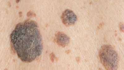 Vücudunuzda o lekeler varsa dikkat!