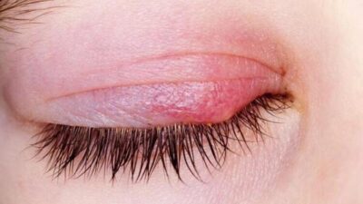 Geçmeyen arpacık neyi işaret ediyor? Sarımsak sürenler…