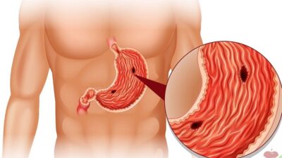 Dikkat! Ülseri bitiriyor! Kabuğunu…