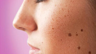 Yüzdeki benleri yok eden yöntem…