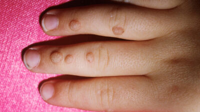 Tek çaresi buymuş! Suyunu sıkıp…