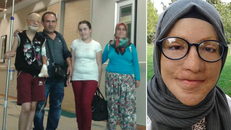 Bursa’da 2 yaşındayken yüzü yanarak tanınmaz hâle gelen Buse Kamalı,