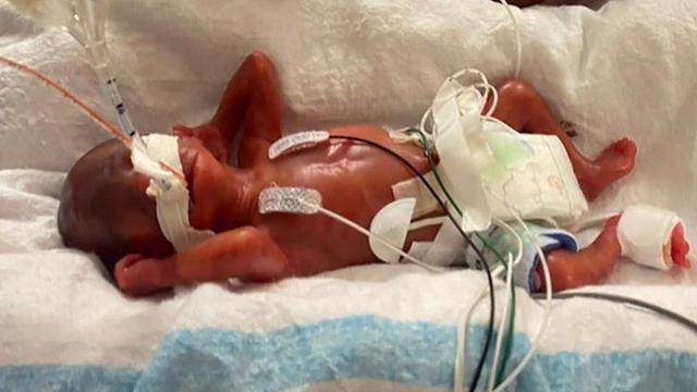 Dünyanın en prematüre bebeği! 420 gram doğdu