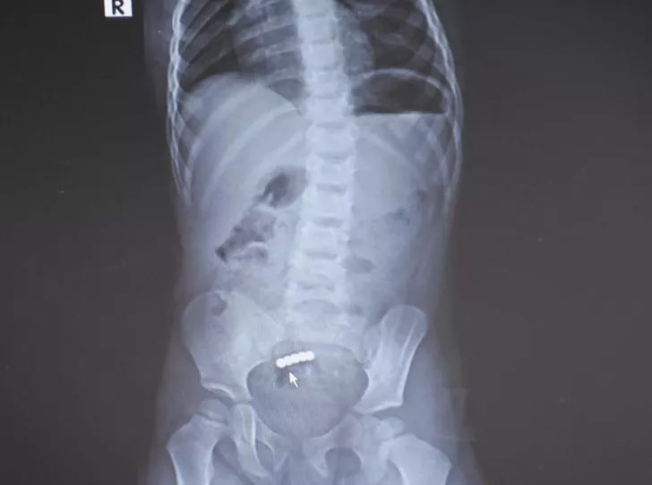 Küçük çocuğun bağırsağından çıktı! Herkesi şaşkına çevirdi