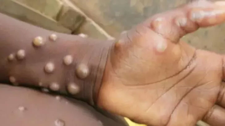 Sayı her geçen dakika artıyor! İki ülkede daha maymun çiçeği virüsü görüldü