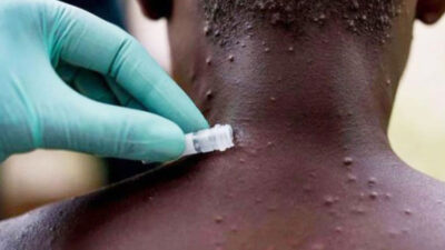 Tehlike büyüyor! Maymun çiçeği vakaları artıyor