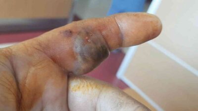 Bursa’da bir adam elini sokan yılanla hastaneye koştu