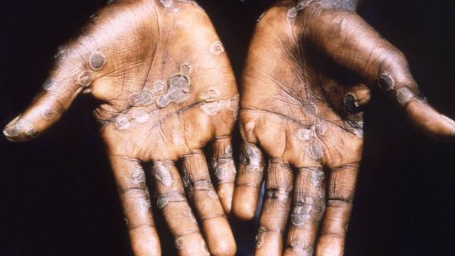 Avrupa’da alarm: Büyük bir salgın haline gelebilir