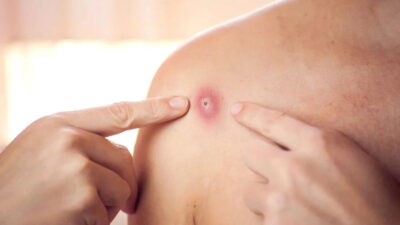 Endişelendiren uyarı: Maymun çiçeği salgını 10 kat büyüyebilir