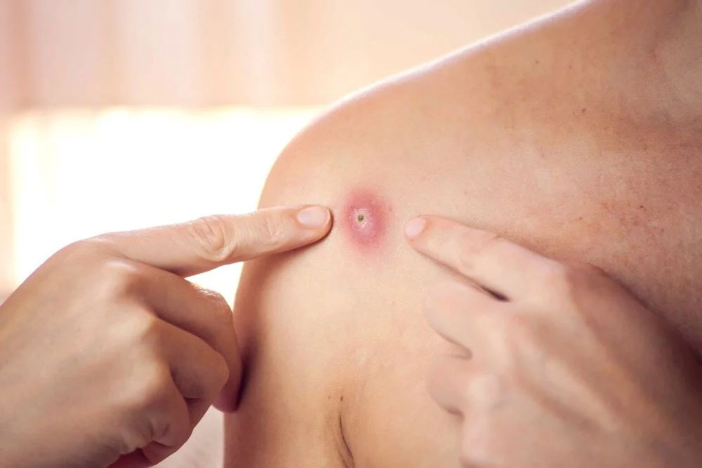 Endişelendiren uyarı: Maymun çiçeği salgını 10 kat büyüyebilir Endişelendiren uyarı: Maymun çiçeği salgını 10 kat büyüyebilir