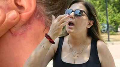 Estetik faciası! Burun kemikleri eriyip düştü