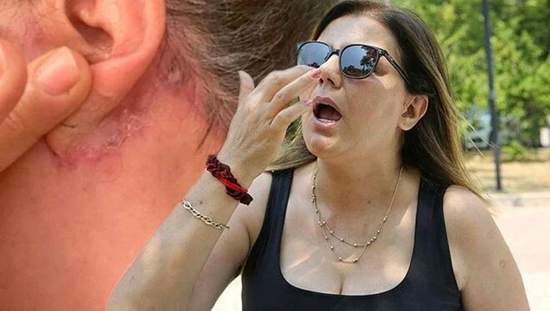 Estetik faciası! Burun kemikleri eriyip düştü