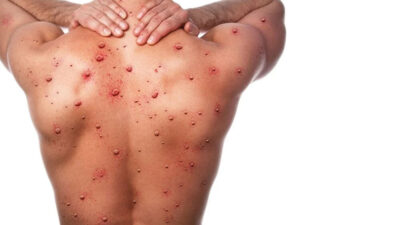 Sağlık Bakanlığı’ndan ‘maymun çiçeği’ rehberi