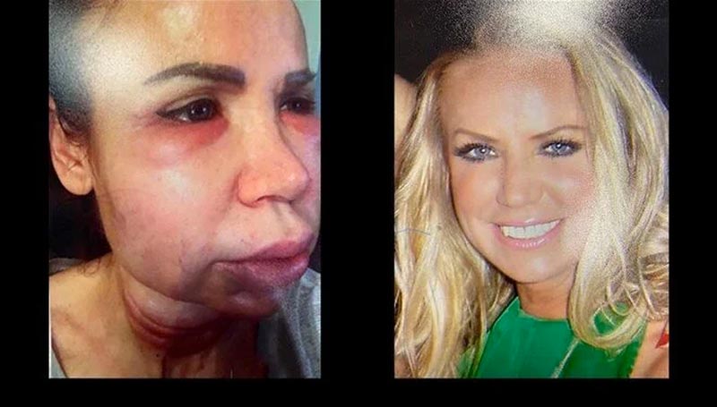 Estetik faciası! Tanınmaz hale geldi Estetik faciası! Tanınmaz hale geldi