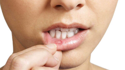 Ağız içindeki yarayı dakikalar içinde bitiriyor!