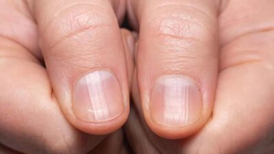 Akciğer kanserini teşhis eden parmak testi…