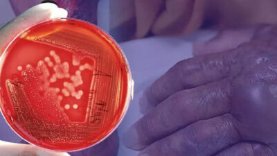 ABD’de korku büyüyor: Et yiyen bakteri vakalarında artış