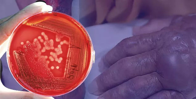 ABD’de korku büyüyor: Et yiyen bakteri vakalarında artış ABD’de korku büyüyor: Et yiyen bakteri vakalarında artış