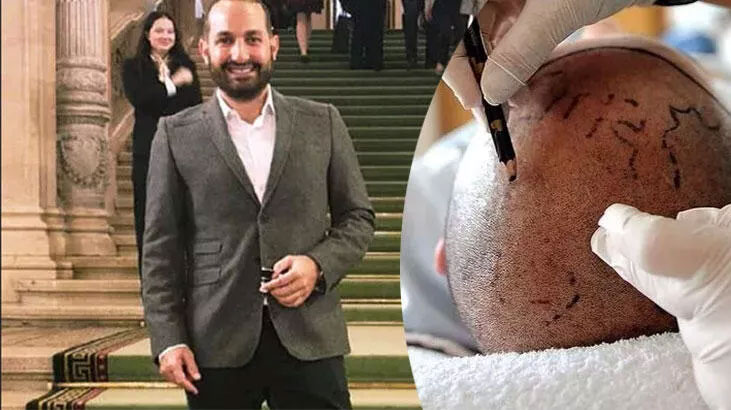 Saç ekimi sonrası hayatını kaybetmişti! Ölüm nedeni belli oldu Saç ekimi sonrası hayatını kaybetmişti! Ölüm nedeni belli oldu