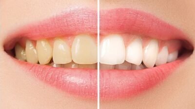 Dişlerinizi en hızlı beyazlatan formül!