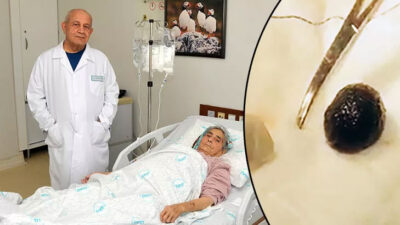 Doktoru şoke eden olay! Safra kesesinden çıkan taş, bağırsağını tıkadı