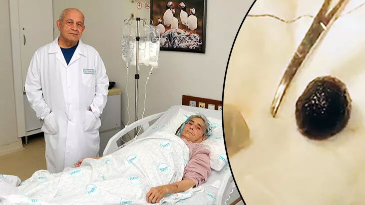 Doktoru şoke eden olay! Safra kesesinden çıkan taş, bağırsağını tıkadı