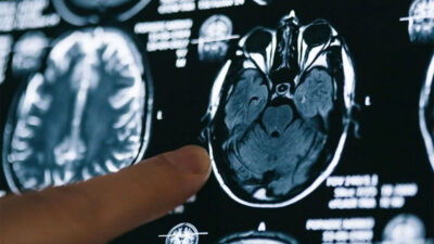 Umut veren Alzheimer ilacı! İlk kez tedavi etti