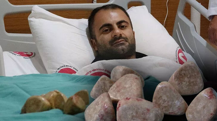 Mesanesinden toplam 550 gram ağırlığında 20 taş çıkarıldı Mesanesinden toplam 550 gram ağırlığında 20 taş çıkarıldı