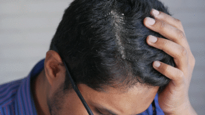 Yıllardır kepeklenme sorunuyla boğuşanlar dikkat! Nedeni…