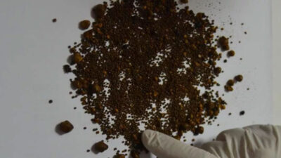 Doktor bile şoke oldu! Safra kesesinden 4 bin 536 taş çıktı