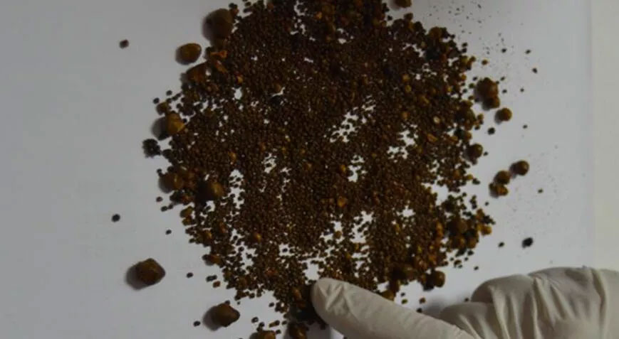 Doktor bile şoke oldu! Safra kesesinden 4 bin 536 taş çıktı