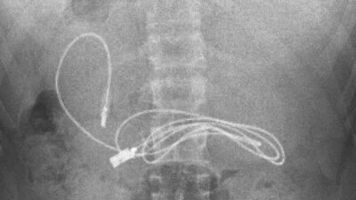 15 yaşındaki çocuğun midesinden çıkanlar şaşkına çevirdi! 1 metrelik şarj kablosu da var