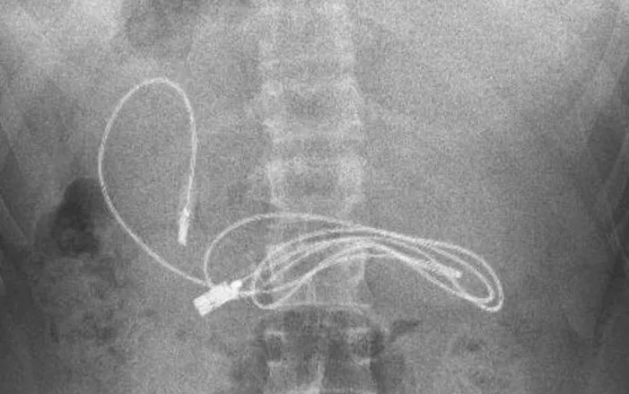 15 yaşındaki çocuğun midesinden çıkanlar şaşkına çevirdi! 1 metrelik şarj kablosu da var