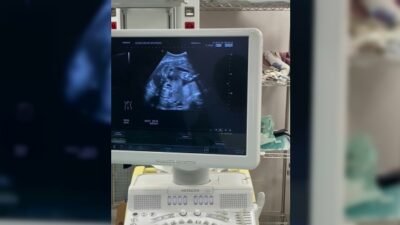 Elazığ’da anne karnındaki bebeğe stent takıldı