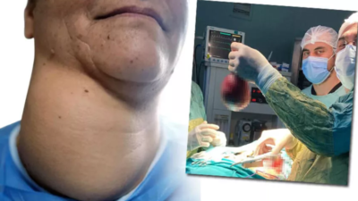 Yıllarca ameliyattan korkan hasta ikna edildi, boynundan 800 gram kitle çıktı