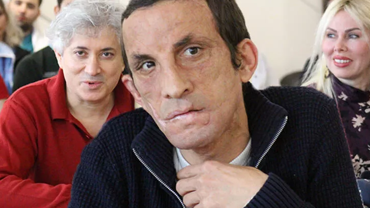 Türkiye’nin ilk yüz nakli! Uğur Acar 11’inci yılını kutladı