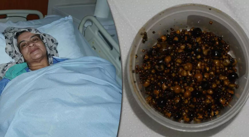 Korktuğu için 20 yıldır ameliyat olmadı, safra kesesinden 2 bin taş çıkarıldı