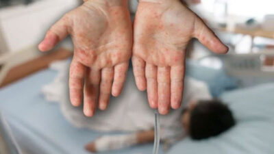 Kızamık vakalarında artış! Bakan Koca: Ölüm yok ancak artış var