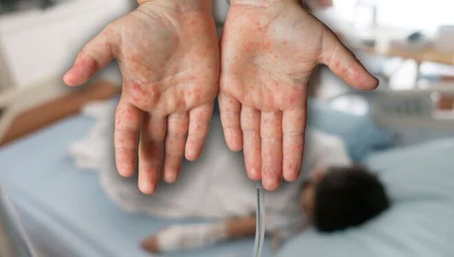 Kızamık vakalarında artış! Bakan Koca: Ölüm yok ancak artış var