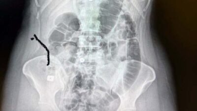 Boynuna takılan implant yemek borusunu yırtıp midesine düştü