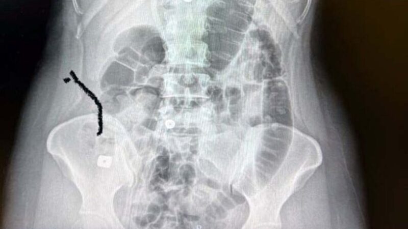 Boynuna takılan implant yemek borusunu yırtıp midesine düştü Kahramanmaraş'ta yaşayan Sultan Tıraş'a (40) boyun fıtığı nedeniyle takılan ve