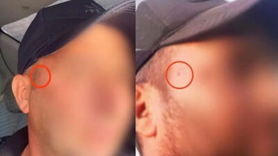 Yakalanma korkusundan yüzündeki beni aldırdı