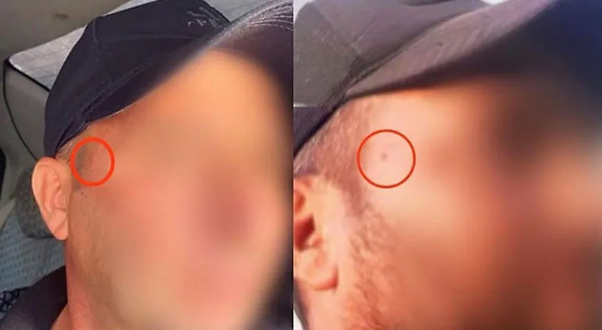 Yakalanma korkusundan yüzündeki beni aldırdı Yakalanma korkusundan yüzündeki beni aldırdı