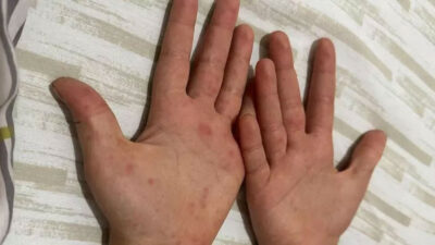 Sağlık Bakanlığı’ndan 81 ile ‘kızamık’ yazısı