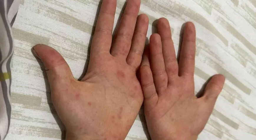 Sağlık Bakanlığı’ndan 81 ile ‘kızamık’ yazısı